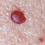 Cherry Angioma